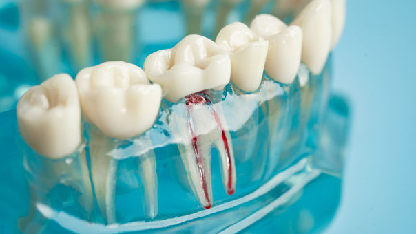 Common Signs You Might Need a Root Canal