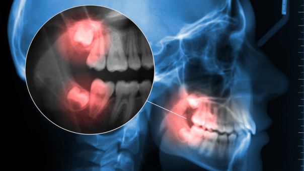 Wisdom Teeth: When to Remove Them and What to Expect