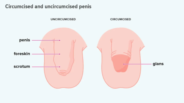 Circumcision: Benefits, Procedure, and Recovery with Dr. Dheeraj Shamsukha